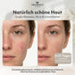 Azelainserum gegen Rosacea, Rötungen & Akne