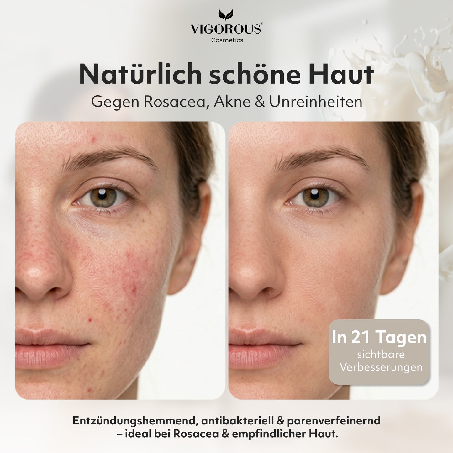 Azelainserum gegen Rosacea, Rötungen & Akne